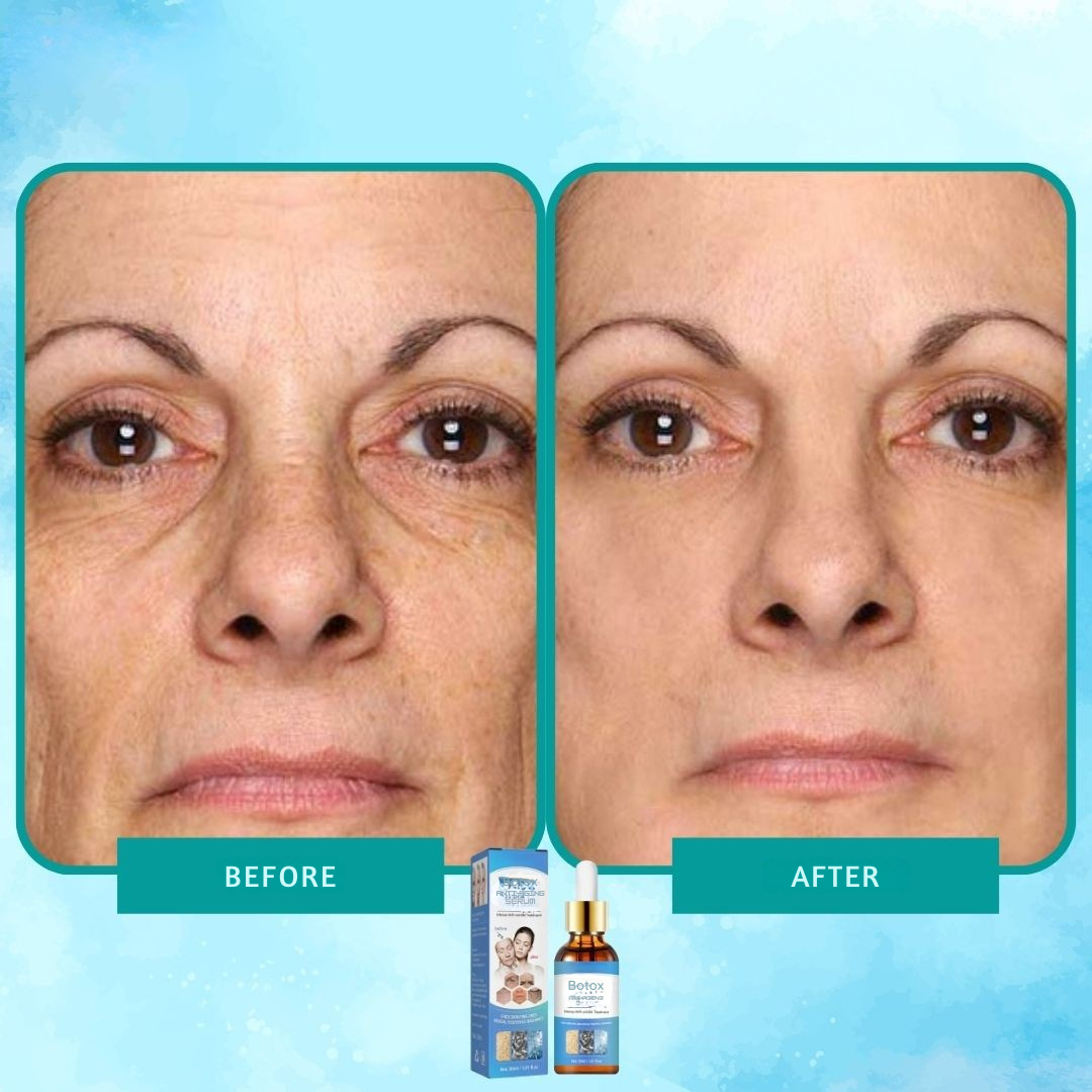 Intenzív ránctalanító Botox szérum elixír 